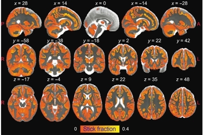 成像增強技術(shù)讓腦部炎癥首次可視化